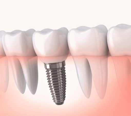 avantages de l’implant dentaire