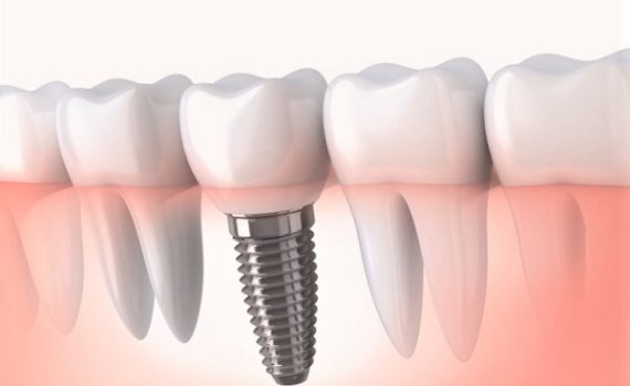 avantages de l’implant dentaire