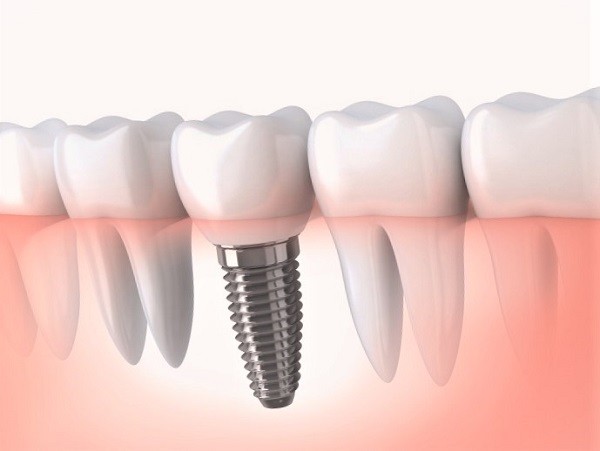 avantages de l’implant dentaire